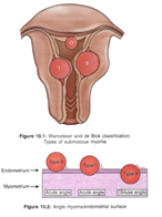 Mioma uterino submucoso: qué es, tipos, síntomas y tratamiento 2 mioma submucoso